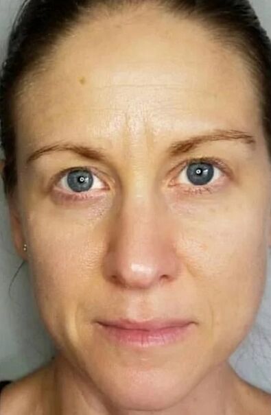 Simpla 360 helped rejuvenate the skin and lighten stains